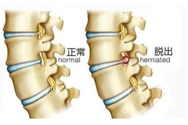 腰椎间盘突出 电脑族