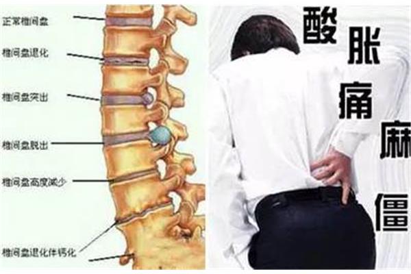 腰椎间盘突出 电脑族