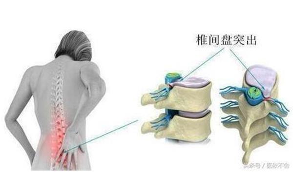 腰椎间盘突出 电脑族